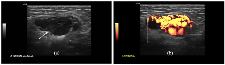 Hernia parte VIII Ecografia tempo formacion.jpg